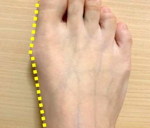間違った外反母趾の治療法のイメージ画像