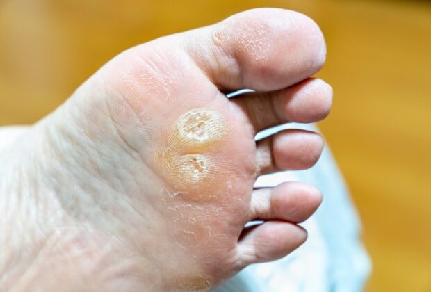 足指の付け根の痛みやウオノメ、タコの原因。のイメージ画像