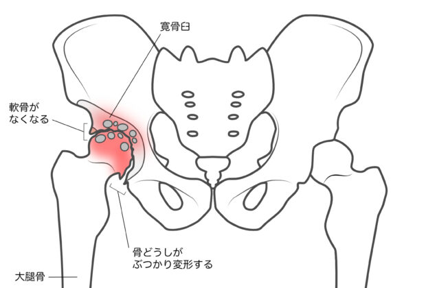 股関節の問題には早目の対応が必要！のイメージ画像