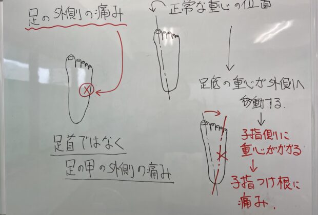 足の小指側の痛みのイメージ画像