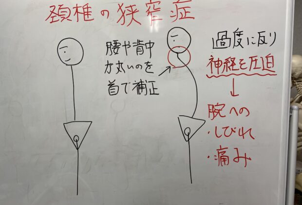 頚椎狭窄症についてのイメージ画像