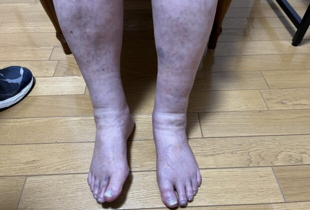 足首のむくみ、腫れのイメージ画像