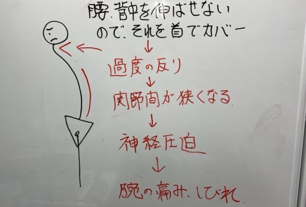 右腕のしびれ、痛み。（頸椎脊柱管狭窄症）のイメージ画像