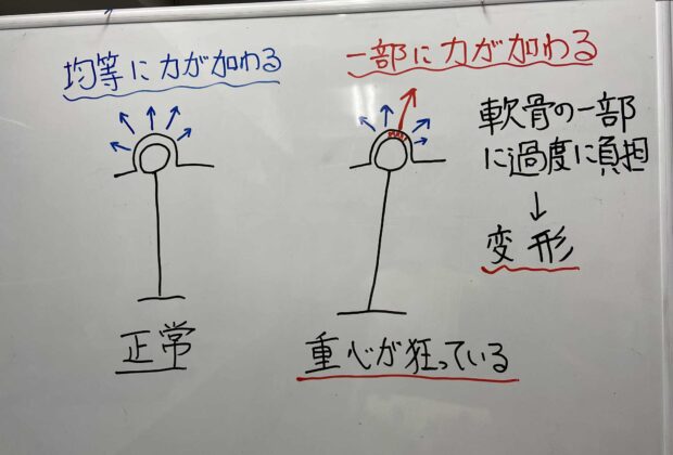 股関節痛（Ｘ線に現れてからでは遅い）のイメージ画像