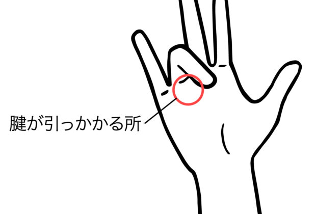 バネ指（弾発指）のイメージ画像