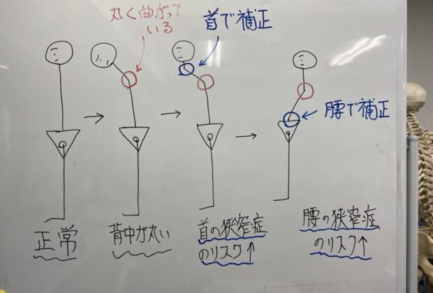 腰や首の狭窄症は手術しか無い？のイメージ画像