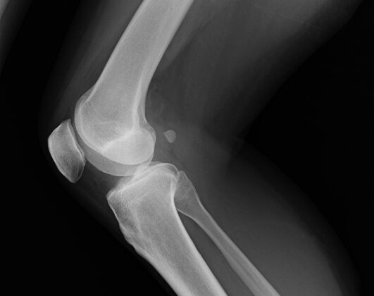 Ｘ線,CT,MRI等に映らない原因不明の症状。(膝)のイメージ画像