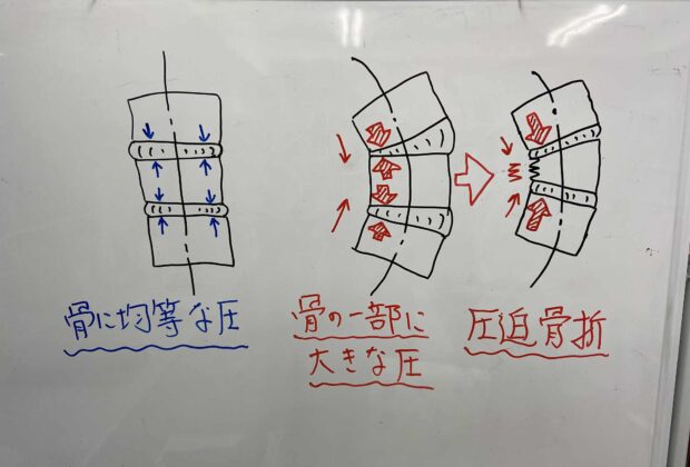圧迫骨折（いつの間にか骨折）の予防のイメージ画像