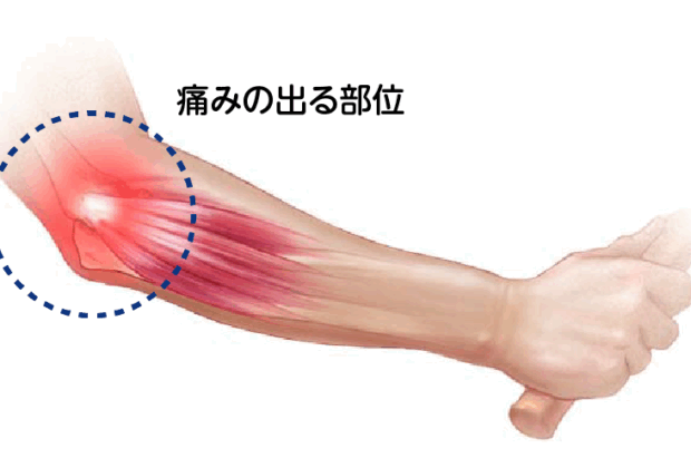 テニス肘（上腕骨外側上顆炎）のイメージ画像