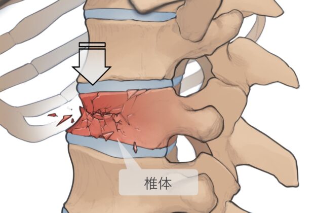 高齢者のギックリ腰のイメージ画像