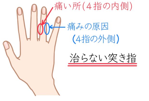 S様50代女性（治らない突き指）のイメージ画像