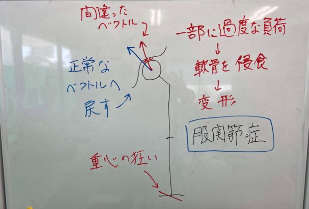 股関節症の意外な原因のイメージ画像