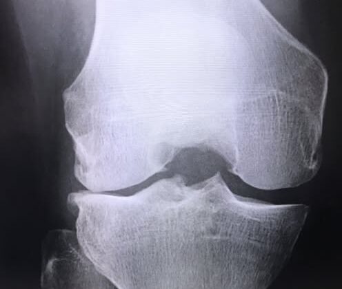 最近関節症が激増しています。のイメージ画像