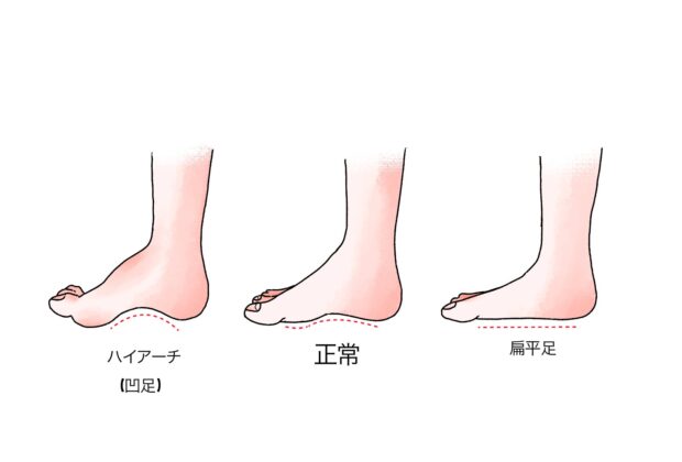 偏平足は異常ではありません。のイメージ画像