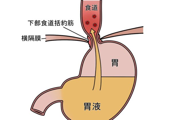 逆流性食道炎（胸やけ）についてのイメージ画像