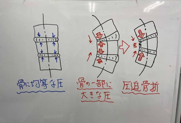 圧迫骨折（いつの間にか骨折）の予防のイメージ画像